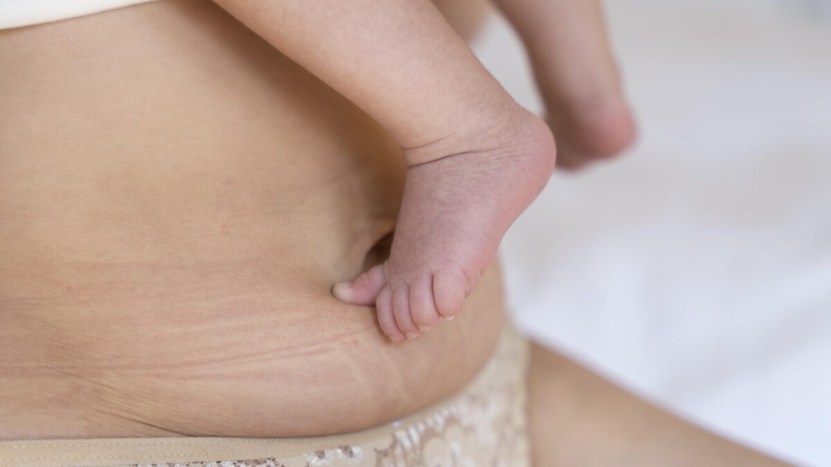 Scar Tape for C‑Sections: What I Learned from a Postpartum Physical Therapist