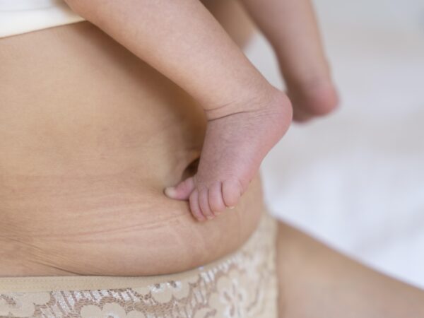 Scar Tape for C‑Sections: What I Learned from a Postpartum Physical Therapist