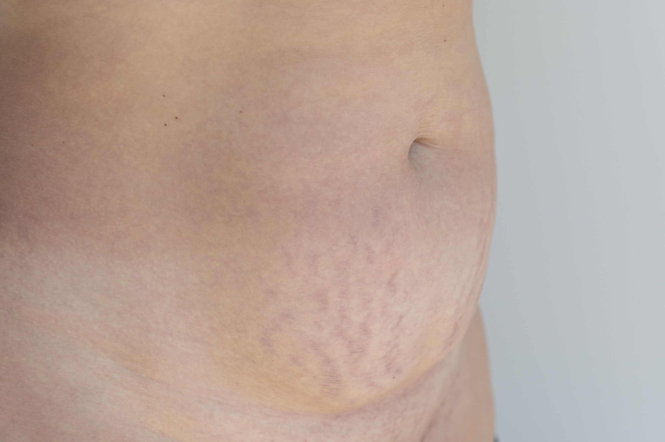 Scar Tape for C‑Section